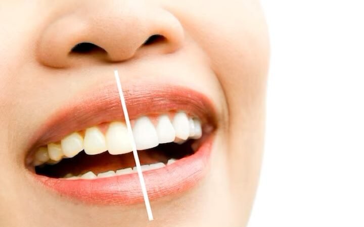 Sbiancare i denti: 4 metodi naturali efficaci