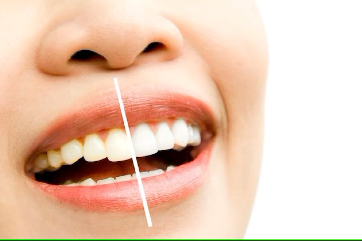 Sbiancare i denti: 4 metodi naturali efficaci