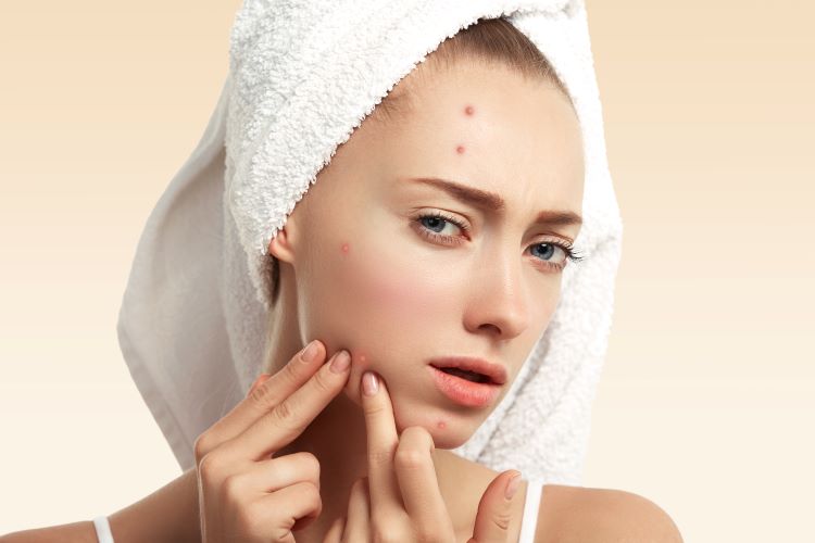 5 metodi naturali per eliminare i brufoli