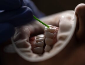 Qual è la causa del sanguinamento delle gengive?