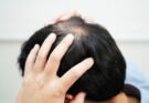 Perdita di capelli: tutto ciò che c’è da sapere su cause e trattamento