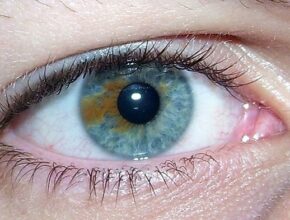Eterocromia oculare: tutto ciò che c'è da sapere