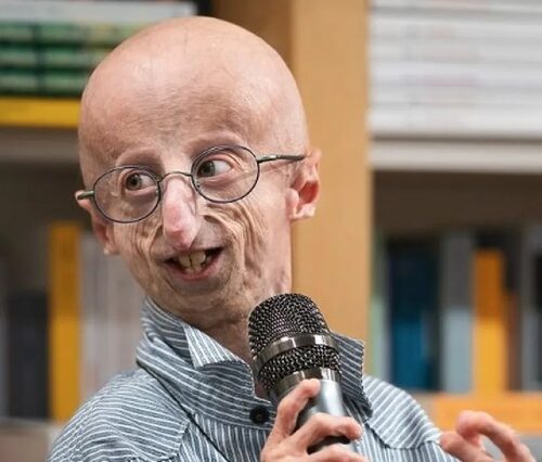 Sammy Basso: chi era e cos'è la progeria?